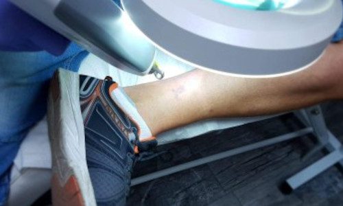 Laserowe usuwanie tatuażu, rozjaśnianie tatuażu, usuwanie makijażu permanentnego, laser pikosekundowy | PROPAGANDA TATTOO & PIERCING | Studio tatuażu i piercingu Poznań. Sklep biżuteria do piercingu Poznań. Szkolenia z piercinu Poznań. Laserowe usuwanie tatuażu Poznań.